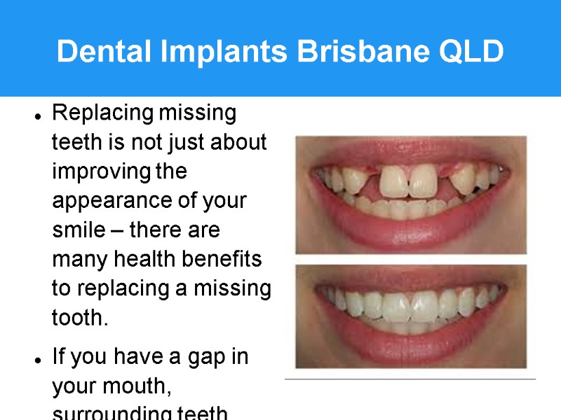 Dental Implants Brisbane QLD Replacing missing teeth is not just about improving the appearance